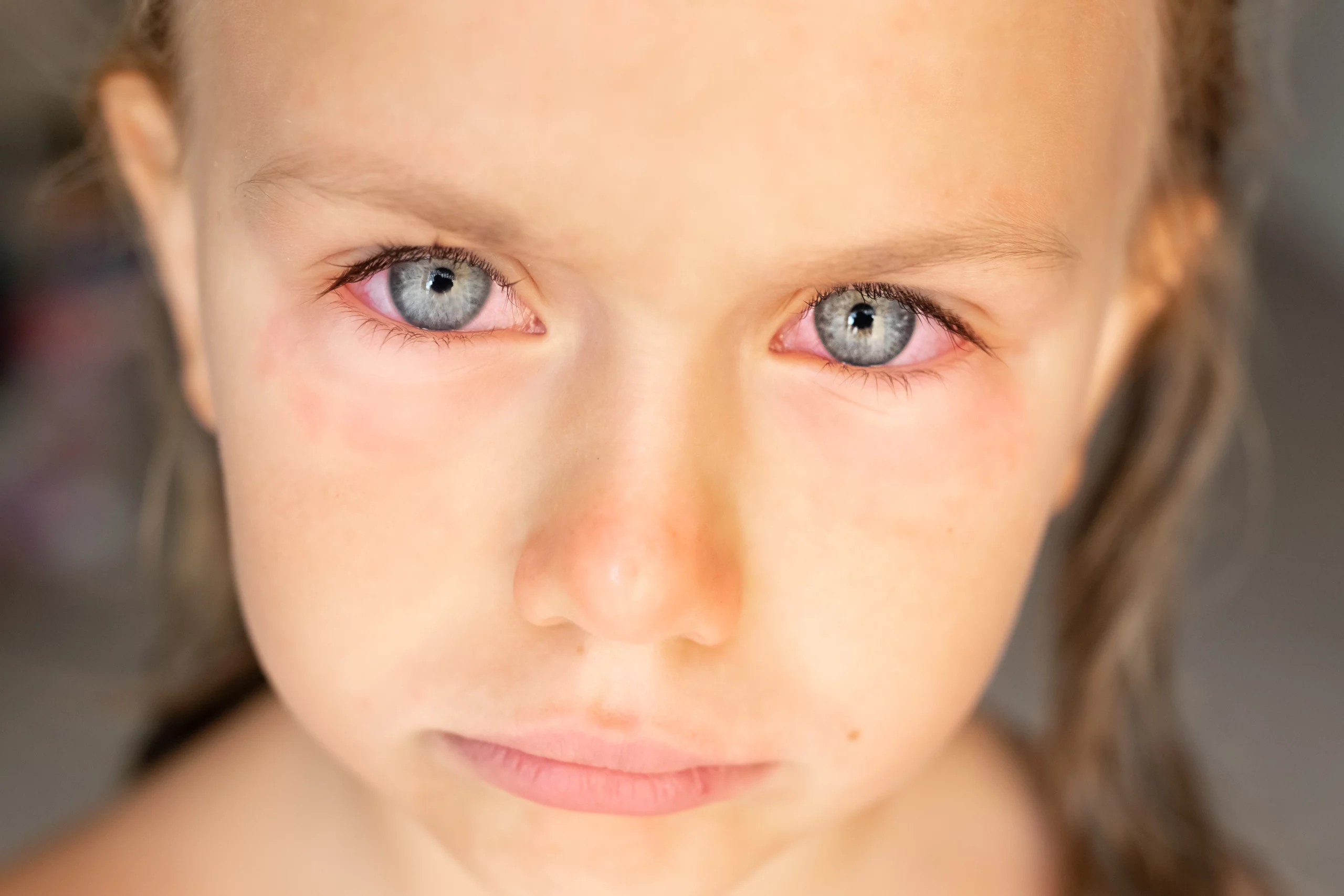 Protecting Your Child From Conjunctivitis This Monsoon